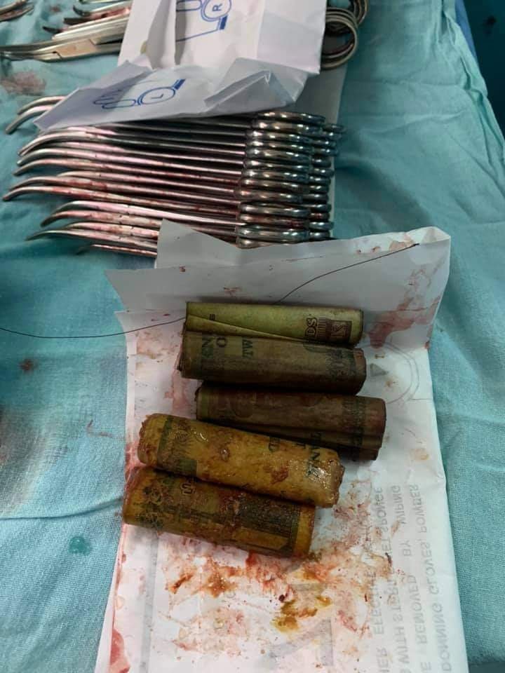 غرائب داخل بطون المرضى.. أموال وأدوات مطبخ وبرص ومنشار كهربائي 2