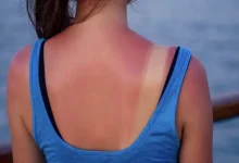 حروق الشمس